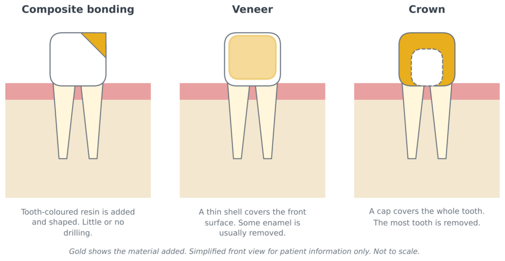 Diagram comparing composite bonding, a porcelain veneer and a crown, showing how much of the tooth each covers